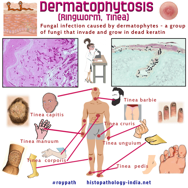 Tinea Corporis (Ringworm) - Online Dermatology