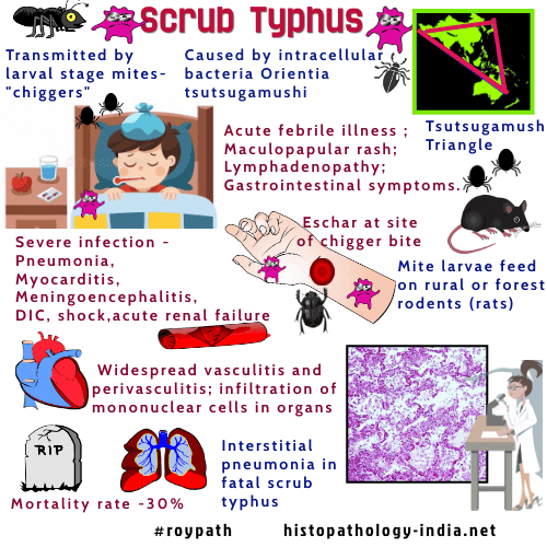 Pathology Of Scrub Typhus Tsutsugamushi Disease Dr Sampurna Roy MD