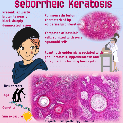 seborrheic keratosis histology