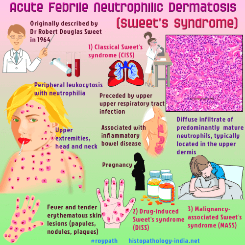 Sweet Syndrome Symptoms