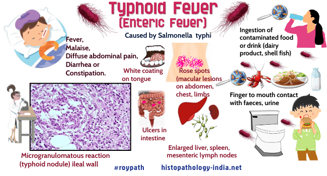 Pathology Of Typhoid Fever Dr Sampurna Roy Md