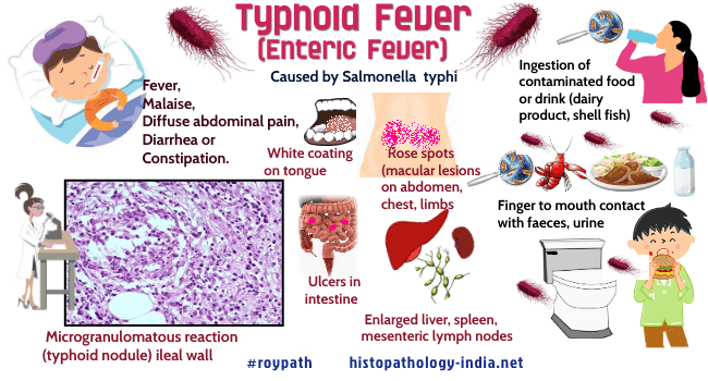 Pathology Of Typhoid Fever Dr Sampurna Roy MD