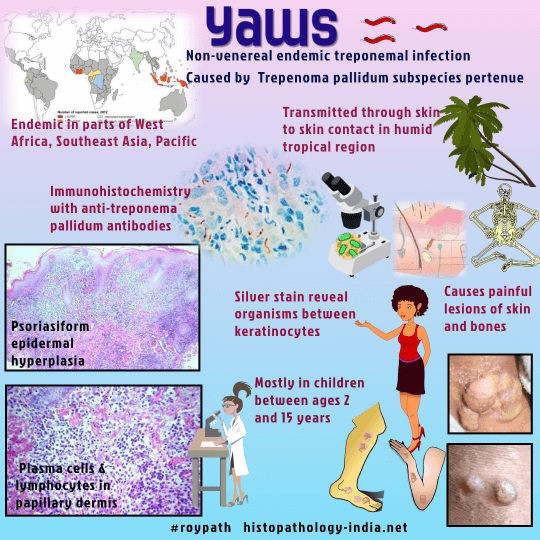 Pathology Of Yaws Dr Sampurna Roy MD Pathology Of Yaws Dr Sampurna Roy MD